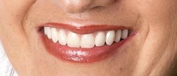Get Smiling Again with fixed teeth in a day by the dental implant professionals united-smile-centres_testimonial_smile.jpg